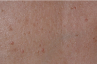 red spot removal - after treatment