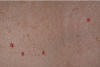red spot removal - before tretament