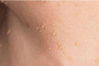 skin tag removal - before treatment