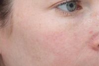 laser treatment