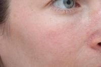 laser treatment