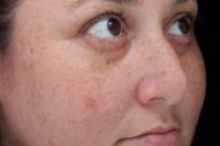 Moxi Laser Treatment - Before skin treatment