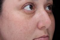 Moxi Laser Treatment - After skin treatment