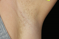 laser hair removal - before