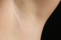 laser hair removal - after