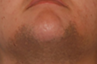 laser hair removal - before