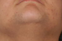 laser hair removal - after