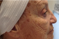 deep laser skin resurfacing - before
