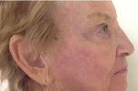 deep laser skin resurfacing - after