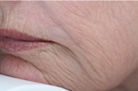 laser skin resurfacing - before