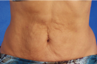 skintyte skin treatment - before