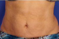 skintyte skin treatment - after