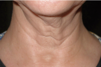 skintyte skin treatment - before