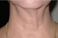 skintyte skin treatment after
