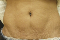 skintyte skin treatment - before