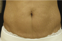 skintyte skin treatment - after