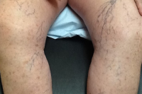 asclera treatment for veins - before