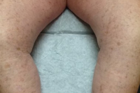 asclera treatment for veins - after