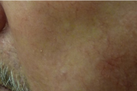blood vessel treatment - after