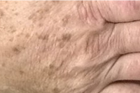 brown spot hand treatment - before