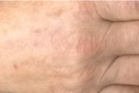 brown spot hand treatment - after