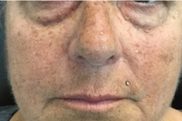 injectable fillers