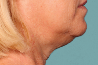 kybella - before