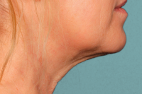 kybella - after