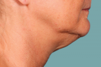 kybella - before