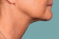 kybella - after