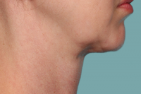kybella - after