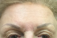 botox - after