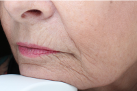 injectable fillers - before