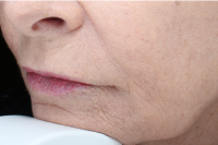 injectable fillers - after