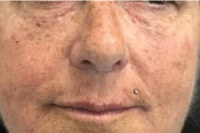 injectable fillers - after