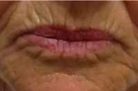 lip line fillers before