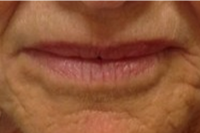 lip lines - after