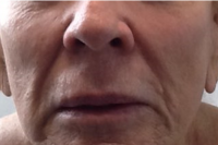 injectable fillers - before