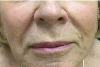 injectable fillers - after