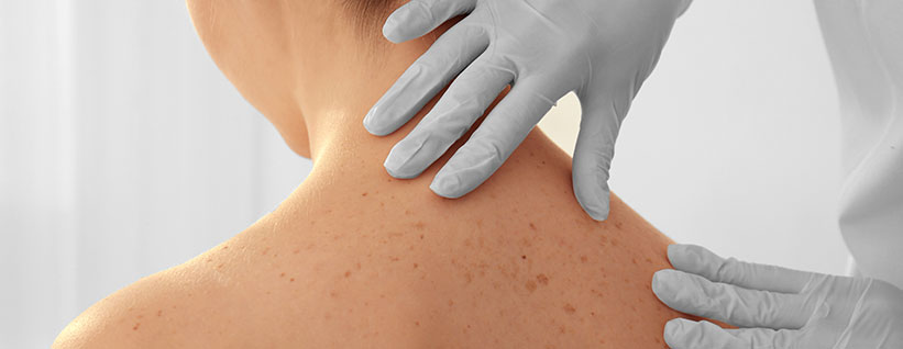 Actinic Keratosis (AK) skin cancer