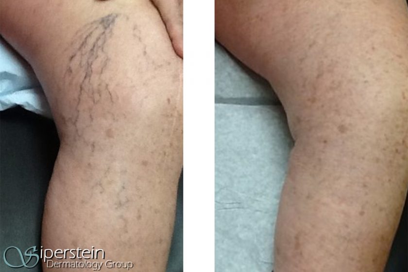 sclerotherapy