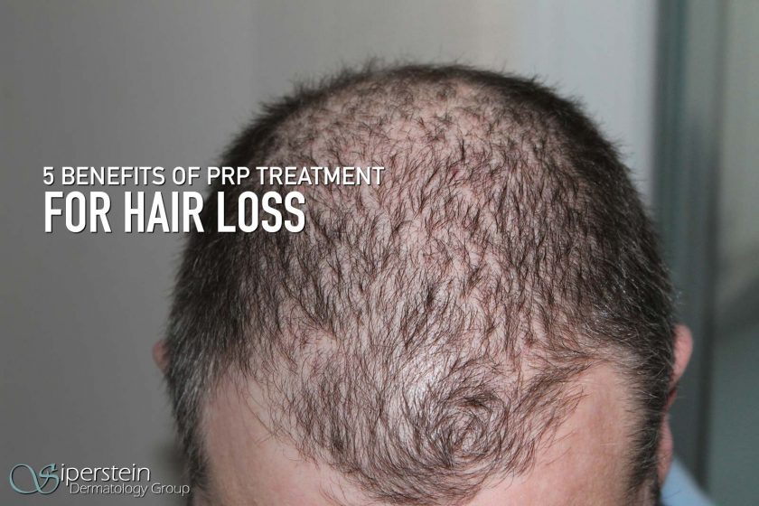 prp-treatment-for-hair-loss