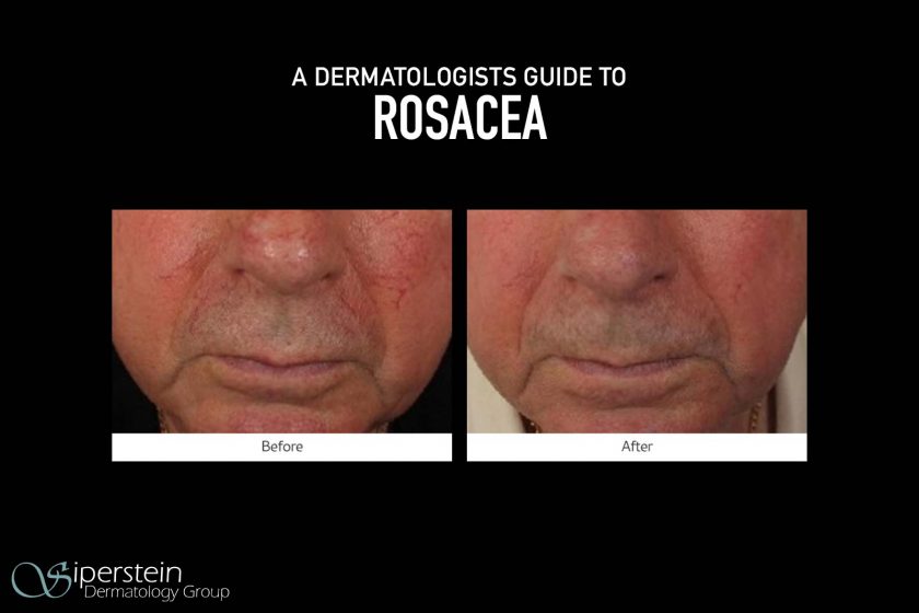 Dermatologists-Guide-To-Rosacea