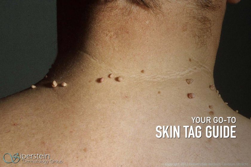 Skin Tag Guide