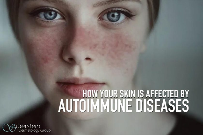 Autoimmune-Diseases