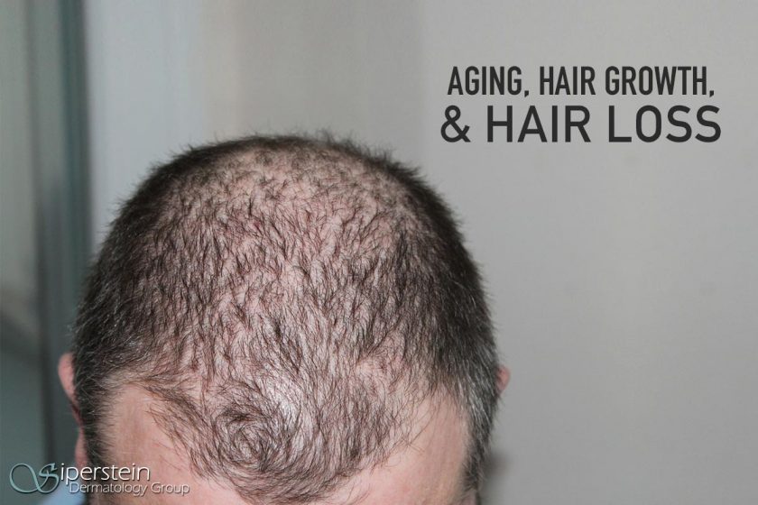 hair loss treatment