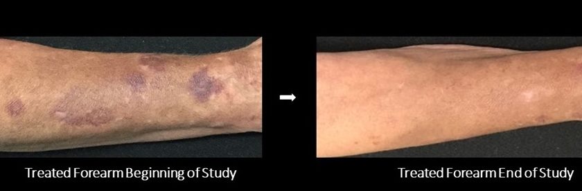 Senile Purpura Treatment - Before and After Images