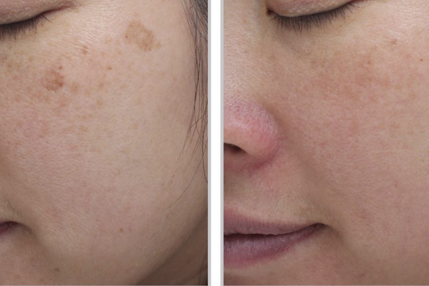 Moxi Laser Before and After Images