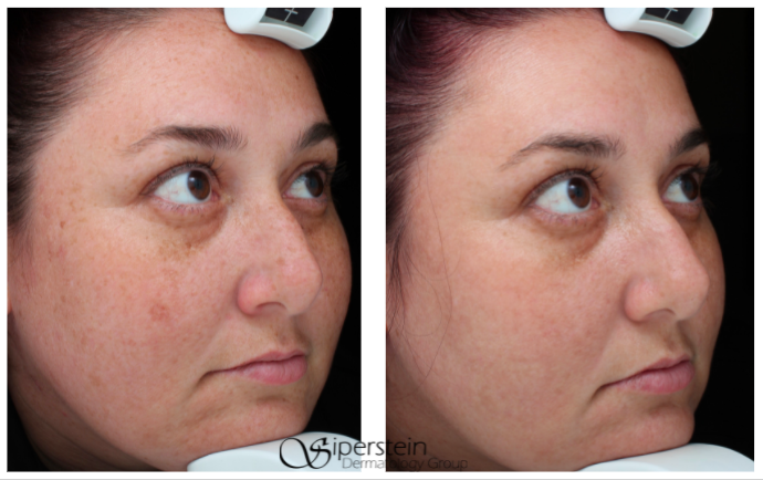 Moxi + BBL laser treatment