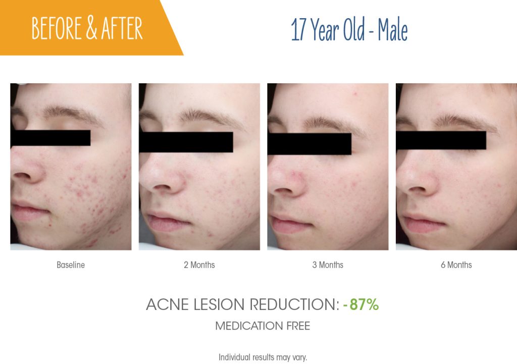 before-after-sebacia
